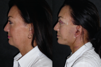 Mini Face And Neck Lift Before And After Photos By Dr Leonard Miller