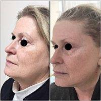 Mini Facelift New York Before And After