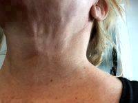 Neck & Face Tuck Surgery With Dr. Ronald J. Edelson