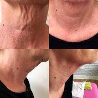 Neck Lift In Chicago Before And After