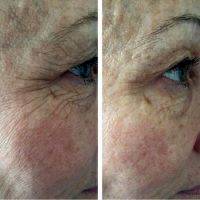 Non Surgical Facelift To Remove Wrinkles
