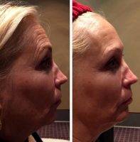 Non Surgical Facelift Tucson Arizona Before And After