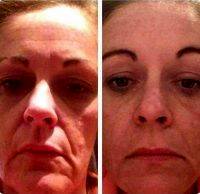 One Hour Facelift Before And After Before And After