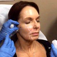 One Hour Miracle Face Lift Pictures