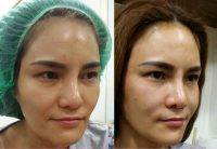 One Stitch Facelift Before And After (1)