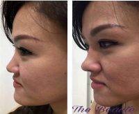 One Stitch Facelift Before And After (11)
