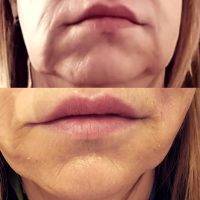 One Stitch Facelift Before And After (13)