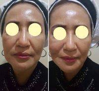One Stitch Facelift Before And After (14)