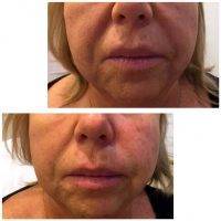 One Stitch Facelift Before And After (19)