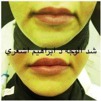 One Stitch Facelift Before And After (4)