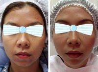 One Stitch Facelift Before And After (5)