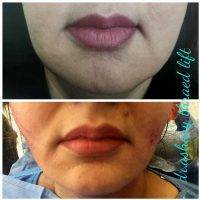One Stitch Facelift Before And After (6)