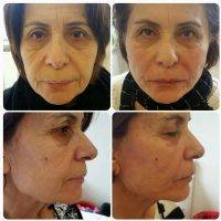 One Stitch Facelift Before And After (8)
