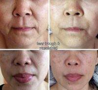 One Stitch Facelift Before And After Photos (1)