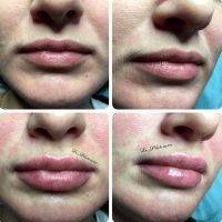 One Stitch Facelift Before And After Photos (10)