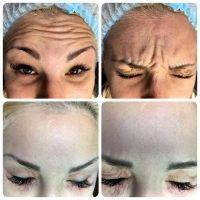 One Stitch Facelift Before And After Photos (11)