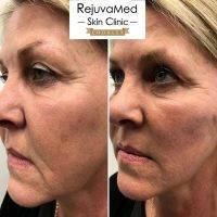 One Stitch Facelift Before And After Photos (14)