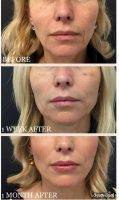 One Stitch Facelift Before And After Photos (15)