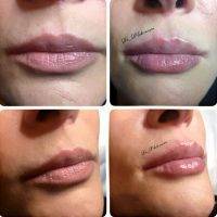 One Stitch Facelift Before And After Photos (16)