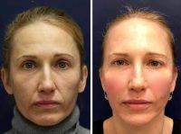 One Stitch Facelift Before And After Photos (19)