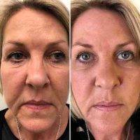 One Stitch Facelift Before And After Photos (3)