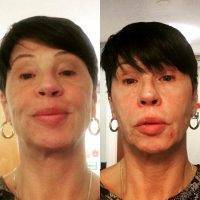 One Stitch Facelift Before And After Photos (4)