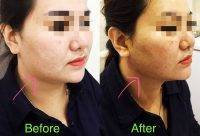 One Stitch Facelift Before And After Photos (8)
