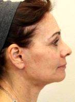 One Stitch Facelift Before And After Pictures (1)