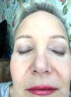 One Stitch SMAS Facelift Before And After (1)