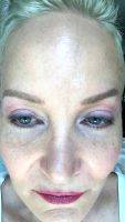 One Stitch SMAS Facelift Before And After (10)