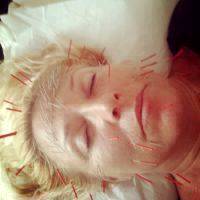 Picture Of Acupuncture Facelift Sydney