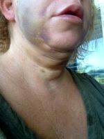 Picture Of Permanent Numbness After Facelift