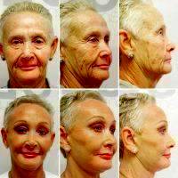 Protect The Results Of A Facelift