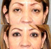 Quick, Simple, And Non-invasive Non Surgical Facelift