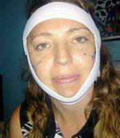 Recovery After Cervicofacial Rhytidectomy