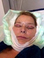 Recovery After The SMASectomy Facelift