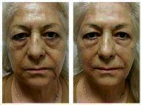 Reducing Wrinkles, Creases, And Folds