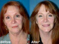 Removing Excess Fat, Tightening Underlying Muscles, And Redraping The Skin Of Your Face And Neck