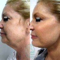 Restore A Youthful, Smooth Look To The Neck And Lower Third Of The Face