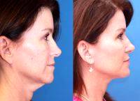 Rhytidectomy Can Produce Incredible Age-defying Results.