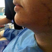 Skin Excision Only Facelift Photo