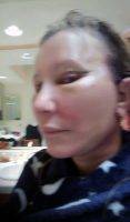 Swelling After Facelift Treatment Picture (4)