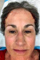 Swelling After Facelift Treatment Picture (7)