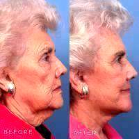 The Facelift, Or Rhytidectomy In Beverly Hills