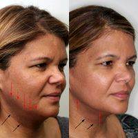 The Facelift Procedure Photo Before And After