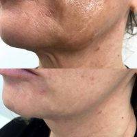 The One Stitch Face Lift Is A Minimally Invasive Procedure Offering Face Lift Like Results