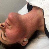 Thermage Effective Neck