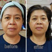 Thermage Face Before And After Photo