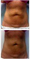 Thermage For Tummy Tightening Before And After