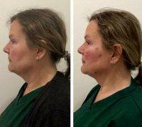 Thread Facelift Before And After Photo